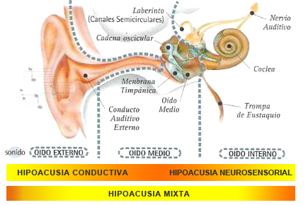hipoacusia